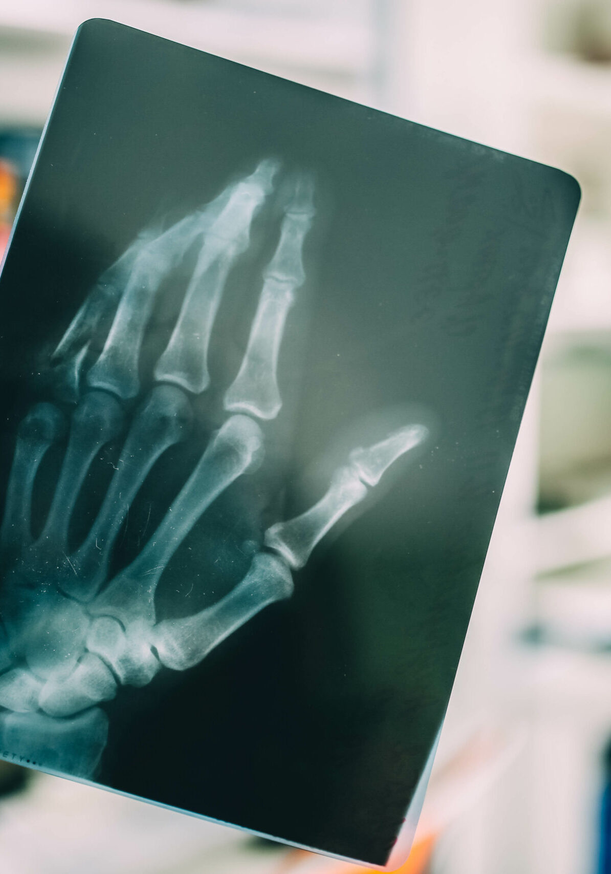 X-ray picture of a hand with a broken little finger, the concept